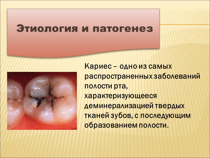 Этиология и патогенез Кариес – одно из самых распространенных заболеваний полости рта, характеризующееся деминерализацией